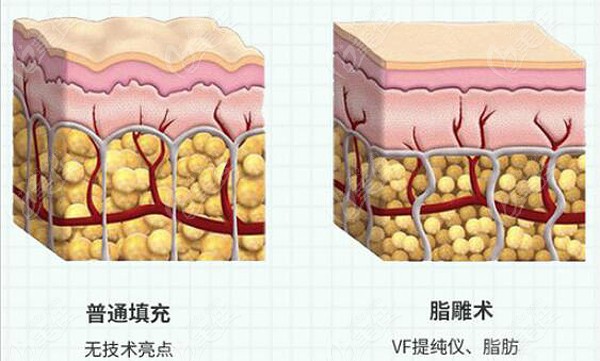 脂雕多少钱-脂雕多久可以恢复